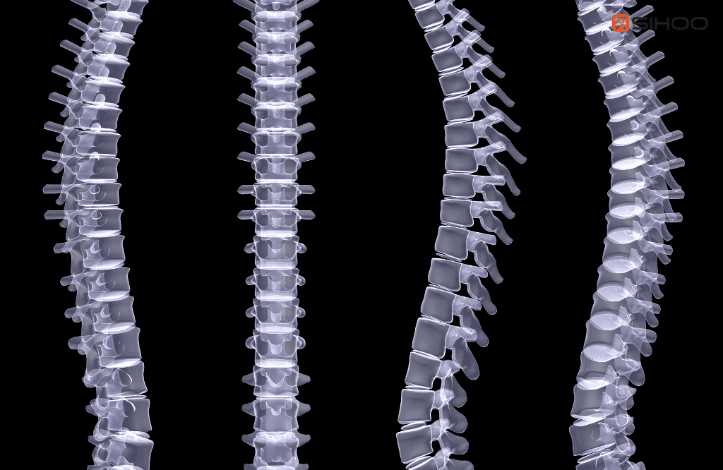 Spondylolisthésis et sédentarité au bureau que faut-il savoir